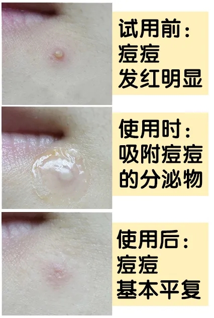 片仔癀痘痘贴效果怎么样,片仔癀清痘系列真的有用嘛