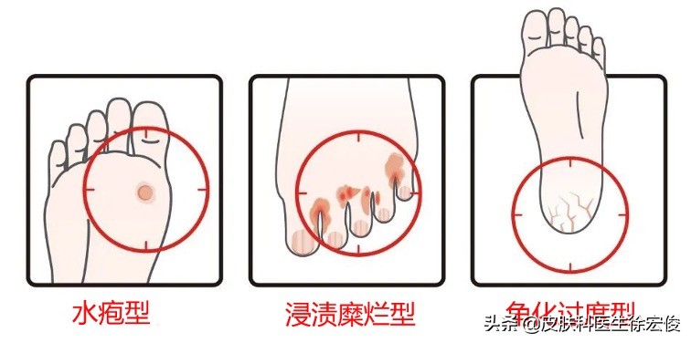 去脚气小妙招水泡型脚气,夏天脚气高发怎样就可以一次根治