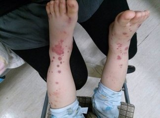 怎么治疗过敏性紫癜最有效最快,治疗过敏性紫癜的关键是