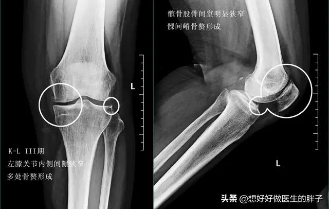 膝盖有骨刺应该注意些什么,膝盖骨刺正确处理办法