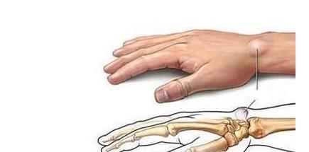 手腕腱鞘囊肿没肿但是痛怎么处理,手腕突然鼓起硬包摸起来不痛