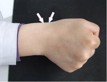 腕部腱鞘囊肿怎么治疗,奶奶抱孩子累得腱鞘炎怎么办