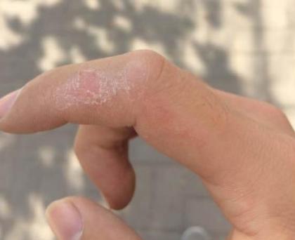 502把衣服和手粘住了怎么去除,用502胶粘住手怎样去除胶