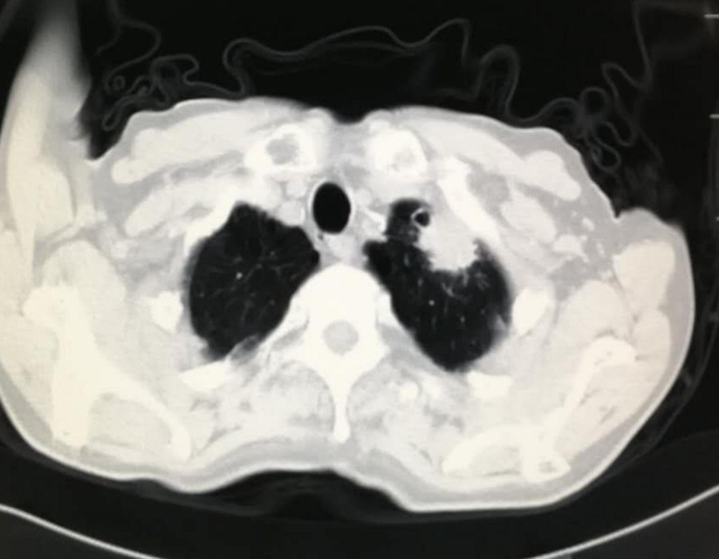 肺癌长期生存或治愈有不同吗,肺癌未治疗活了11年怎么解释