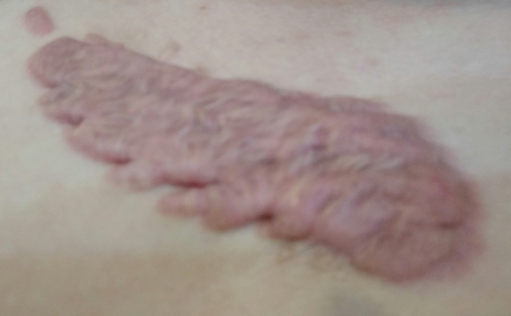 疤痕疙瘩用32p敷贴有效果吗,敷贴治疗疤痕疙瘩用啥仪器