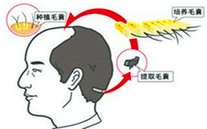 种头发到底有没有效果,种头发有用吗要多少钱