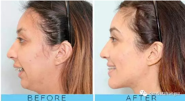 深覆合加深覆盖如何矫正,深覆合深覆盖同时存在如何矫正