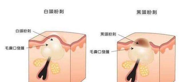 鼻子上挤出来的白色条状怎么治疗,鼻子上挤出来的黄米粒怎么办