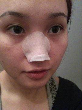 鼻子上挤出来的白色条状怎么治疗,鼻子上挤出来的黄米粒怎么办