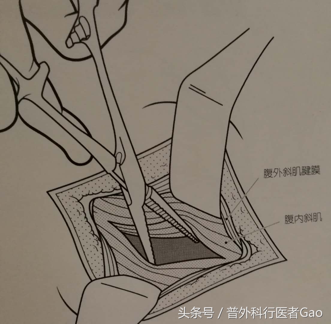 鏉忎粊鑳芥不闃戝熬鐐庡悧,鏉忎粊鍒囬櫎