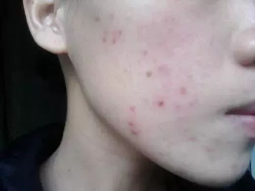 祛痘和祛痘印最好的方法,祛痘和祛痘印的方法一样吗