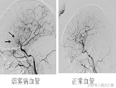 烟雾病病人能怀孕生孩子吗,烟雾病患者能怀孕吗