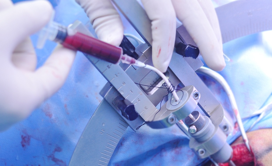 立体定向脑干血肿清除术,脑干血肿清除术