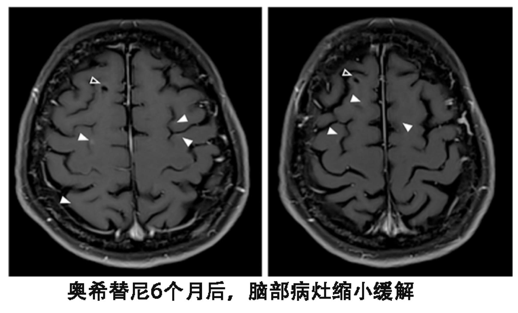 奇迹癌症居然消失了,奇迹肺癌