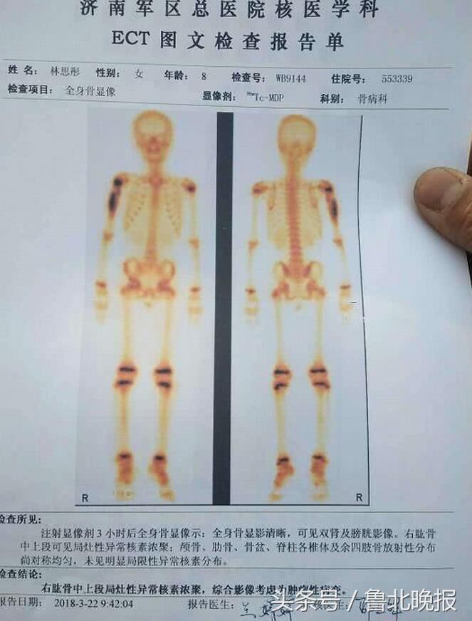 8岁女孩罹患骨癌：“妈妈我不怕疼，我会好的对吗？”