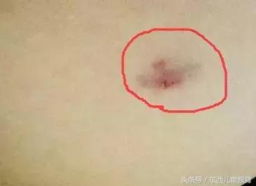 和女儿在小区散步被邻居的宠物狗咬了,划破皮都一定要去打针!