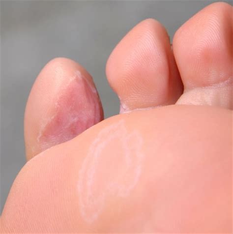 脚气拿什么泡脚好,石榴皮泡脚治脚气