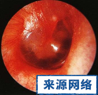 耳朵流水就是流脓,耳朵里流脓血水怎么办