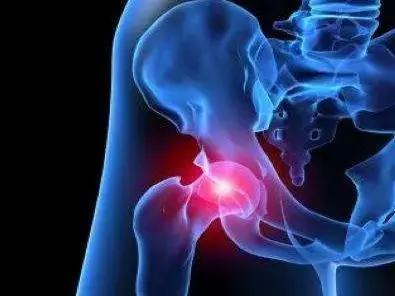 股骨头坏死病因及危险因素,股骨头容易坏死的部位