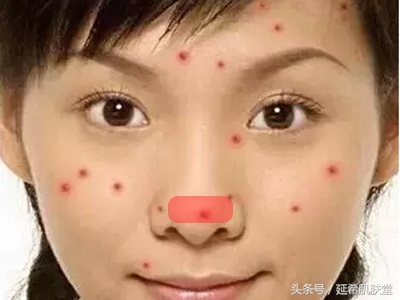 下巴长满痘痘是什么原因怎么调理,下巴不停冒脓包型痘痘怎么样调理