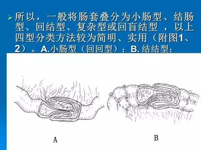 小儿肠套叠空气灌肠需要注意事项,儿童肠套叠空气灌肠要不要住院