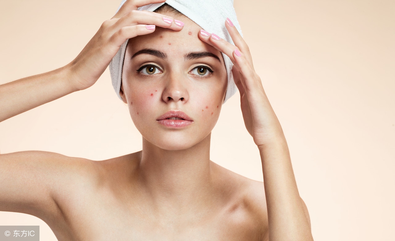 暗疮的症状的照片,暗疮的症状是什么样子的