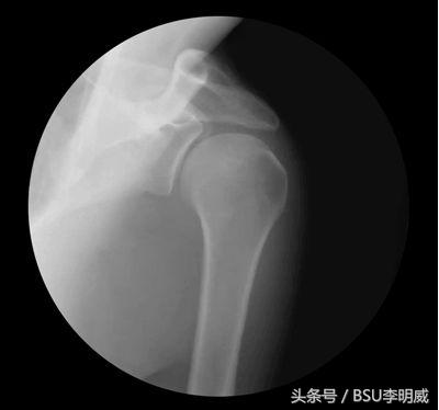 肩关节撞击症如何引起的,肩关节弹响撞击三个动作康复