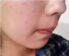 春季换季脸上发红发痒,春季脸上皮肤过敏泛红发痒小妙招