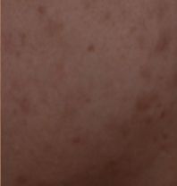 皮肤科医生是怎么祛痘祛痘坑的,皮肤科专家美容祛斑方法