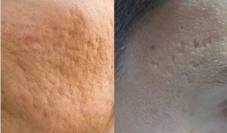 皮肤科医生是怎么祛痘祛痘坑的,皮肤科专家美容祛斑方法