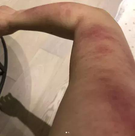 触目惊心！杨丞琳阿娇等人把刮痧过度神话，专家打脸：根本没效果