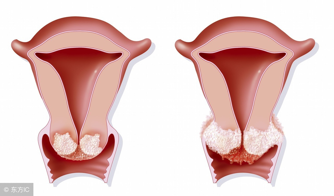 宫颈癌筛查三阶梯试题,宫颈癌筛查高级病变