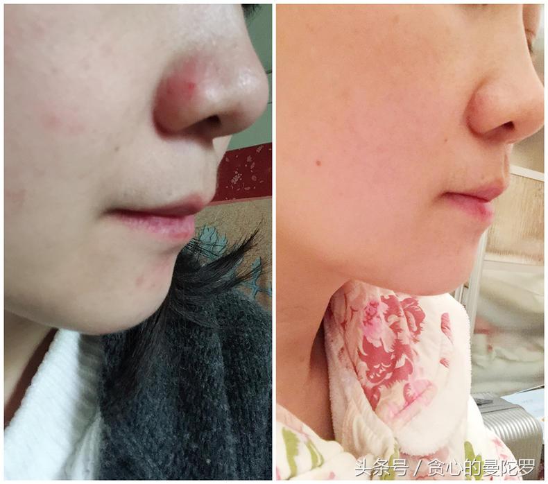 茶树精油祛痘性价比高推荐,茶树精油正品祛痘