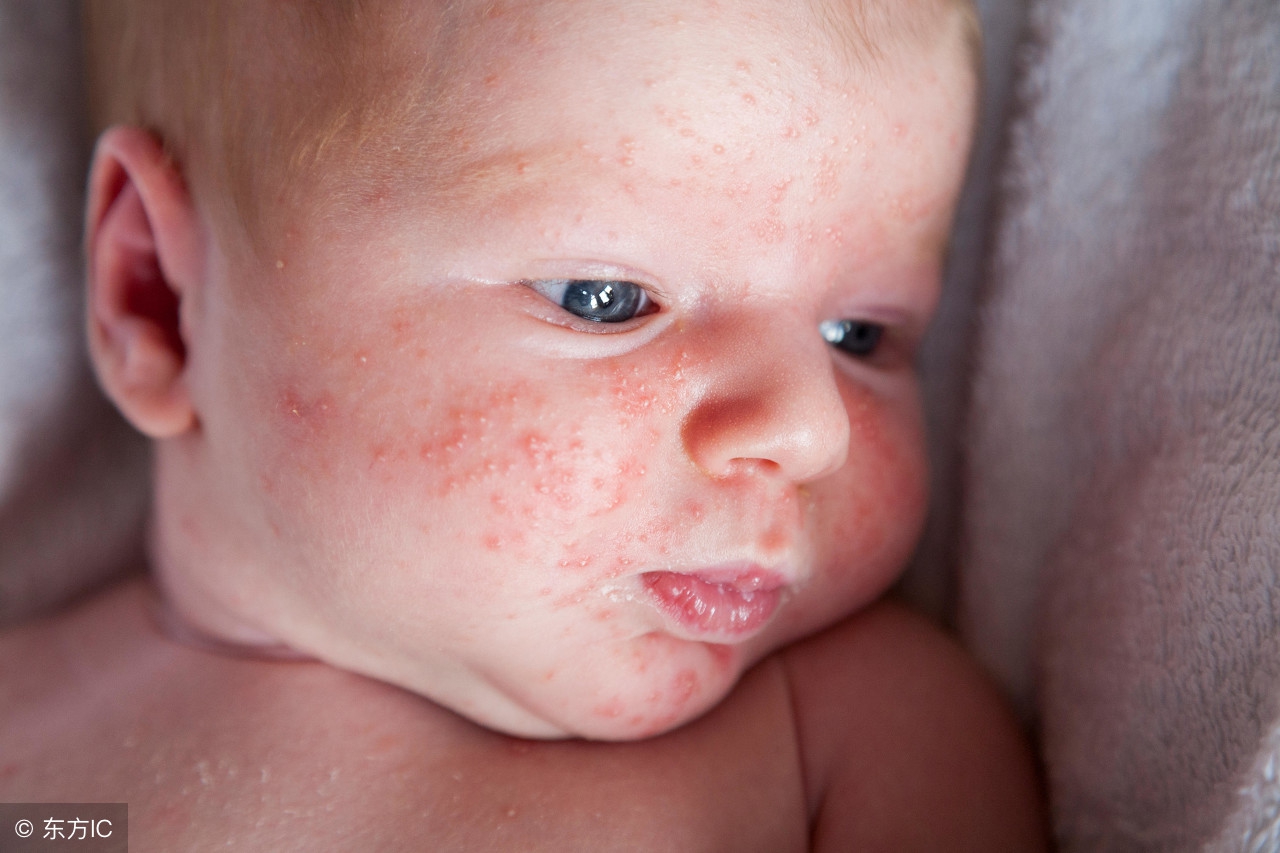 宝宝为什么会长湿疹怎么预防湿疹,宝宝经常长湿疹