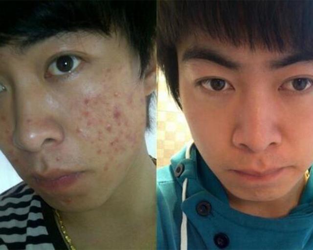 男生祛痘痘和痘印最好最快的方法,男生祛痘淡化痘印最好的方法