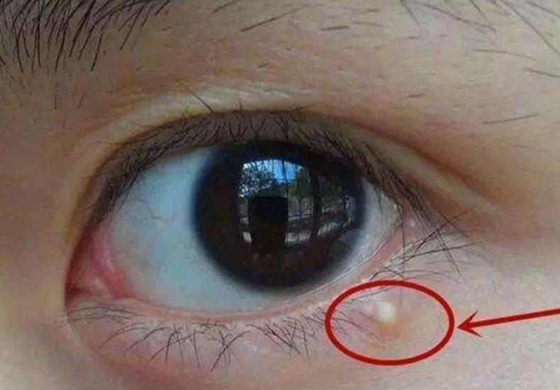 眼角脂肪粒怎么消除,眼角的脂肪粒怎么去除小妙招