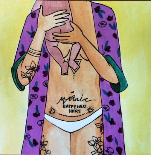 剖宫产并发症怎么治疗,剖宫产并发症是什么