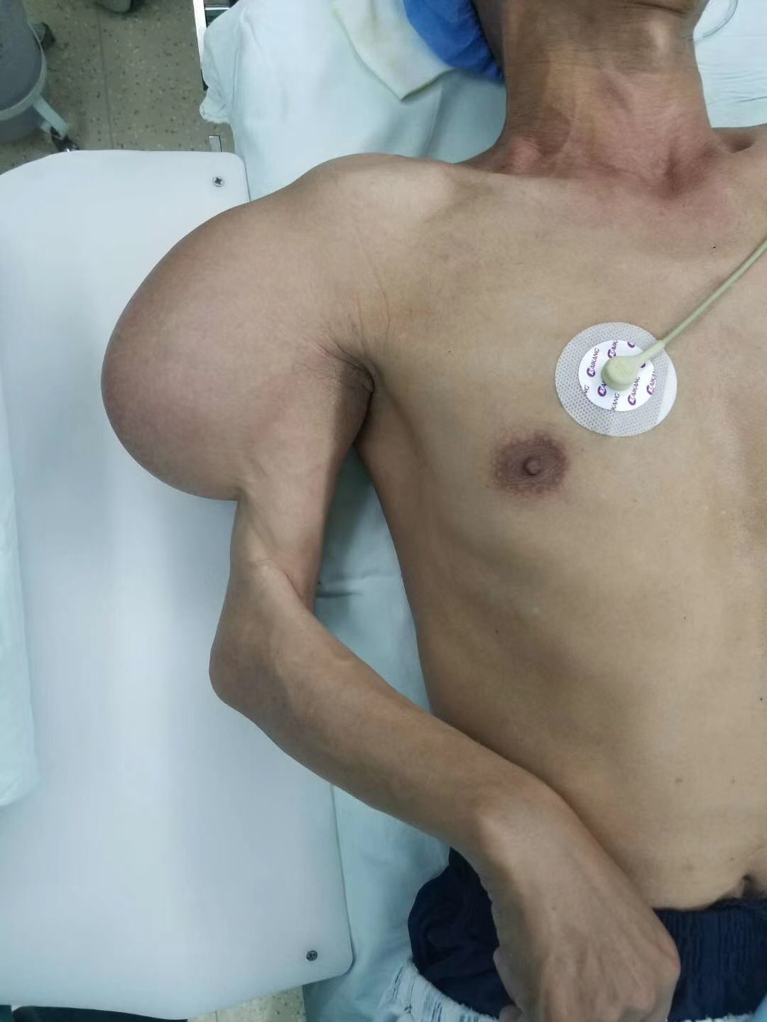 8斤重！堪比巨婴的脂肪瘤在手臂上挂了近30年！