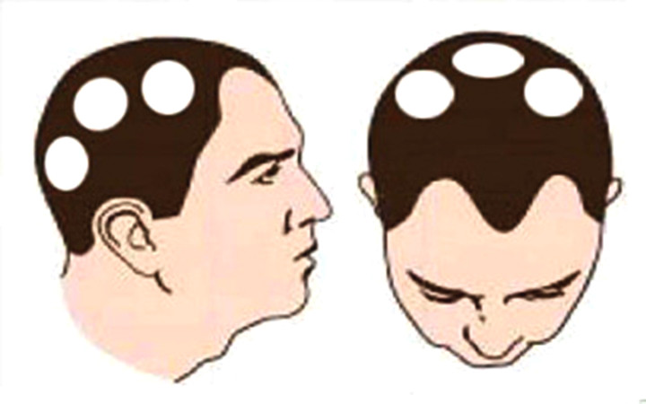 头发变细还脱发,头发漩涡处脱发