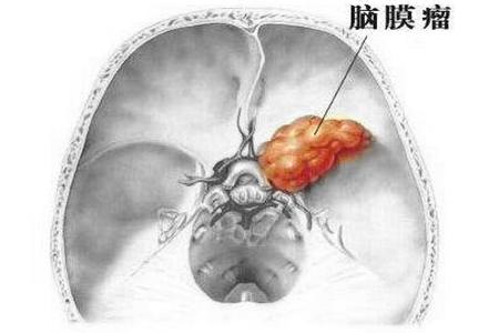 脑膜瘤长什么样,长了肿瘤怎么办