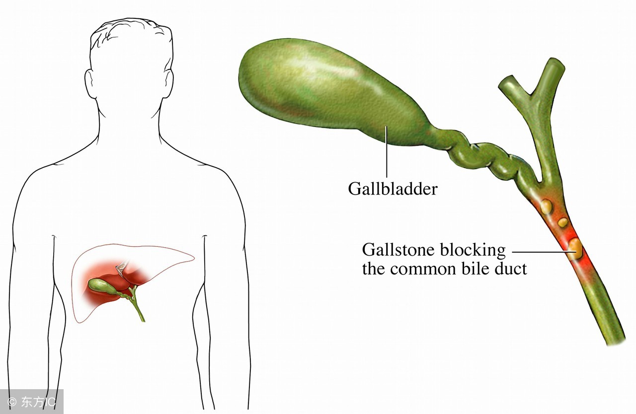 胆结石的联合用药治疗,胆结石的食疗方法哪种有效