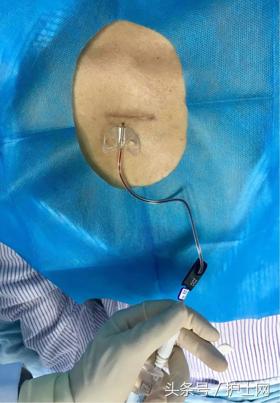 输液港扎针最全示范,输液港拔针的正确方法视频教程