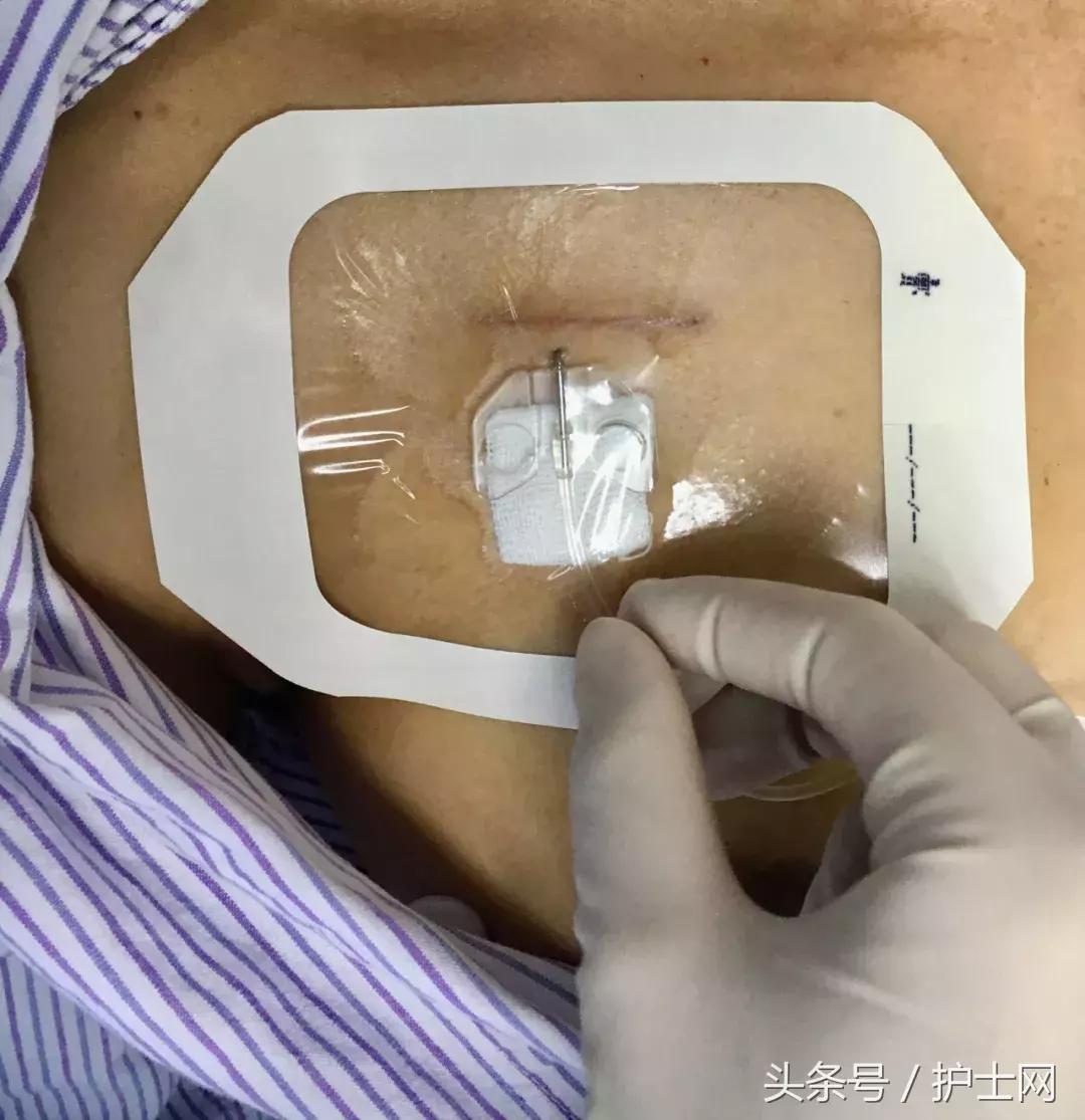 输液港扎针最全示范,输液港拔针的正确方法视频教程