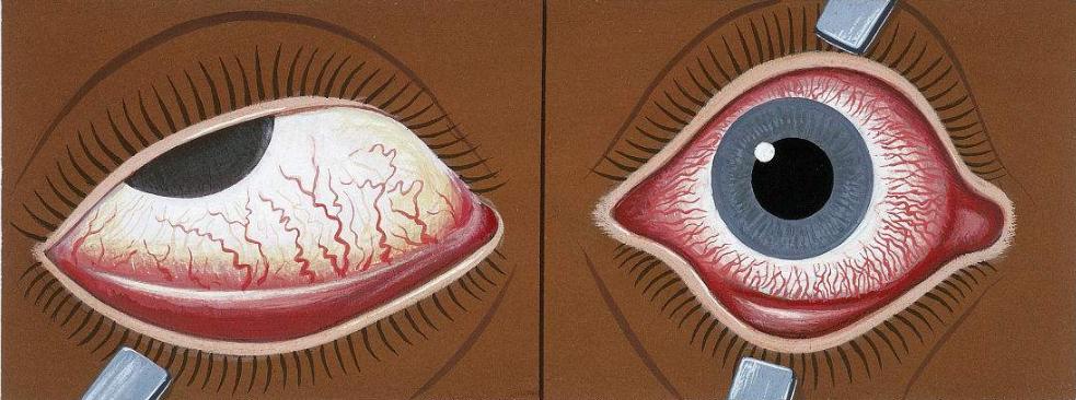 角膜炎结膜炎致眼流泪,角膜炎结膜炎眼部充血用什么药