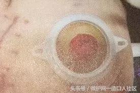 肠造口并发症——造口周围线结反应