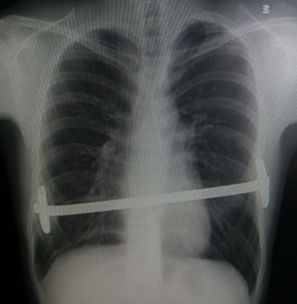 漏斗胸矫正微创手术,最新的漏斗胸微创手术