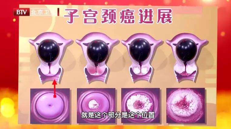 女人腰痛是妇科病引起的吗,女性下腹部隐痛腰痛是不是宫颈癌