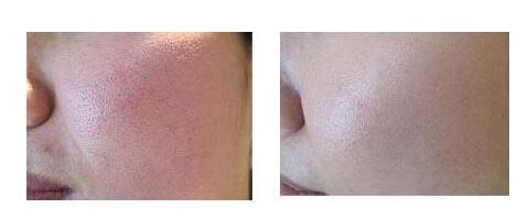 毛孔粗大如何不要钱就能治好,毛孔粗大还有救吗到底要如何解决