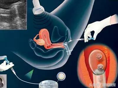 18岁姑娘多次捐卵致生命垂危,女学生捐卵新闻