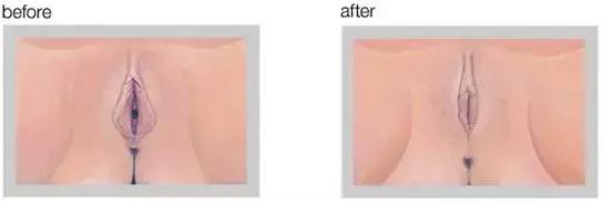 最危险的整容手术是隆胸吗,整容手术隆胸真实案例